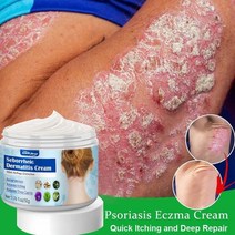빛크림 50g 항균 건선 크림 허브 항 가려움증 여드름 완화 지루성 피부염 발진 치료, 없음