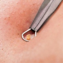 [갓샵] 1+1 이벤트 일본히트 여드름/피지 압출기, 본품