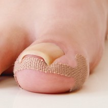 발 발톱 내성 테이프 보호 케어 관리 밴드 테이핑 파고드는 교정 엄지 발가락 패치 풋 펴기 치료 자가 간편한 파고들때 테잎