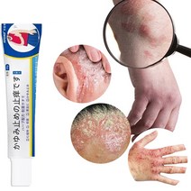 피부가려움증 건선 연고 피부염 모낭염 습진연고, 20g, 1개, 20g