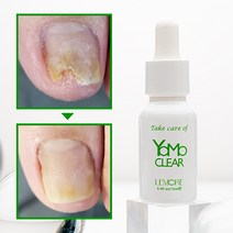 요모클리어 15ml 젤네일 손발톱무좀 발톱무좀 발냄새 문제성 페디솔루션, 2개