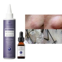 아클레온 사춘기여드름 모공 수축 토너 2종세트 세보엑스 200ml 여드름앰플 15ml, 1개