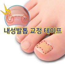 파고드는 내향성 내성발톱 교정 테이프 밴드 30pcs 내성발톱자가치료 발가락통증 교정기 발바닥통증 미지외반증 발톱무좀 내성발톱자가치료 발바닥티눈제거 엄지발가락통증 내성발톱교정기, 1세트(30개입)