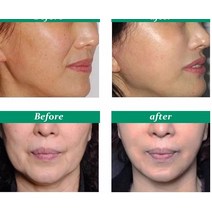 얼굴 리프팅 기계 마사지기 미용기기 입술 주사기 보톡스 필러 3D 조각 LED 조명 사인 소매 메디, 07 Botulax 100U