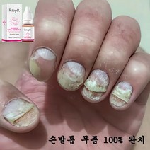 유오노미 발톱무좀 치료약 발바닥 각화형 무좀 발냄새없애는 법 20ml, 1개