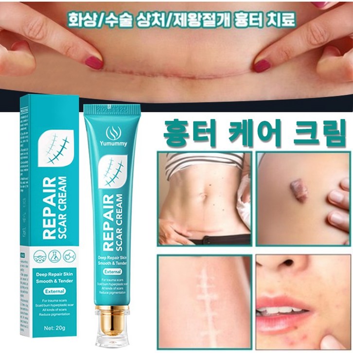 흉터제거연고화상수술흉터 흉터 연고 화상연고, 2개, 20g